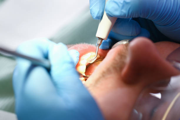 Best Emergency Tooth Extraction in Mason, TN