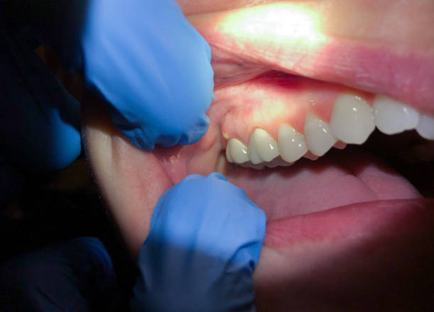 Best Emergency Wisdom Teeth Removal in Mason, TN